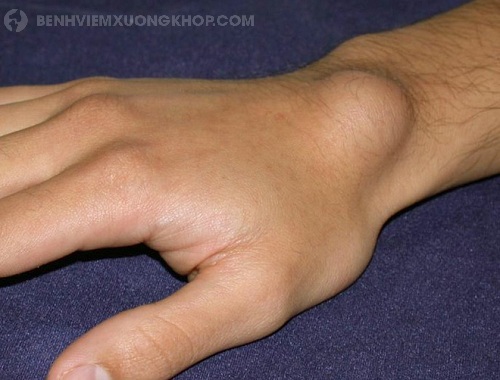 Triệu chứng đau khớp cổ tay và biến chứng