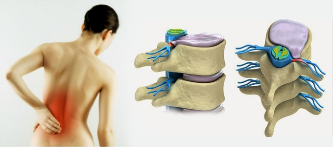 Bênh phồng đĩa đệm khiến người bệnh thường đau tức ở thắt lưng