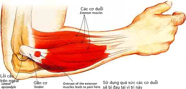 Bệnh viêm khớp khuỷu tay là gì?