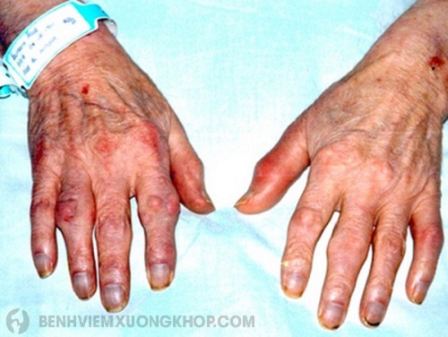 Biến chứng bệnh viêm đa khớp gây bệnh về da