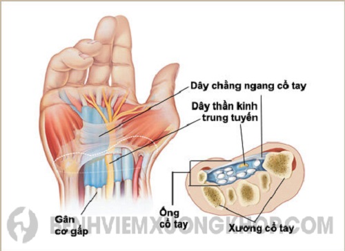 Bệnh đau khớp cổ tay khiến do hội chứng ống cổ tay
