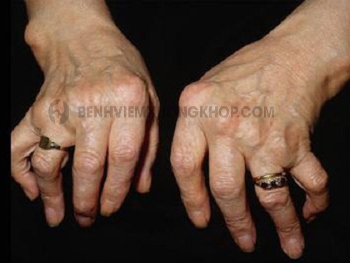 Bệnh đau khớp ngón tay có nguy hiểm không và biểu hiện