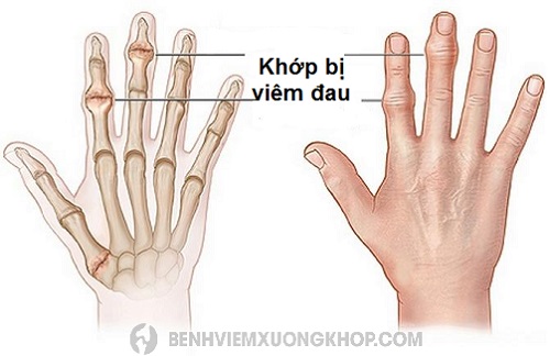 Bệnh đau khớp ngón tay do thoái hóa