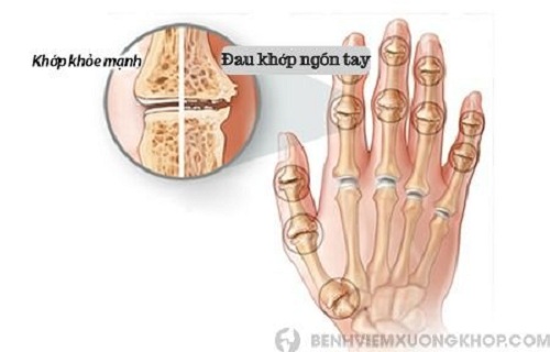 đau khớp ngón tay là gì