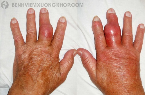 Bệnh gout thường đau ở đâu ngón tay?