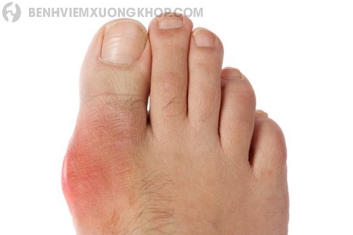Bệnh gout thường đau ở đâu ngón chân?