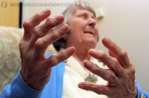 Bệnh thoái hóa khớp tay ở người già