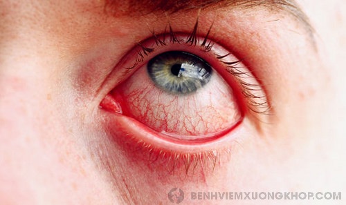 biến chứng bệnh viêm khớp dạng thấp về mắt