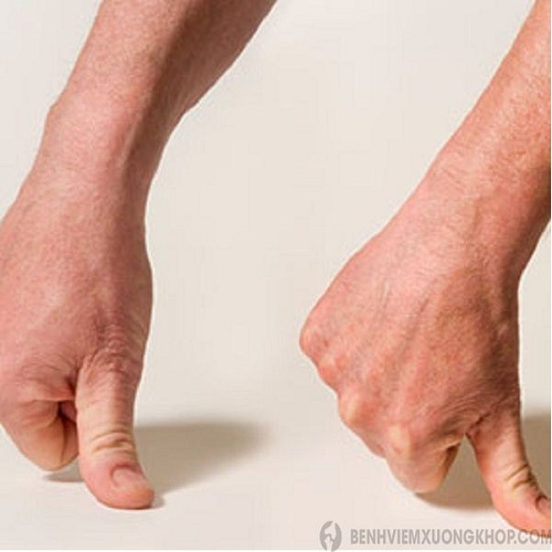 cách chữa viêm khớp cổ tay ngón