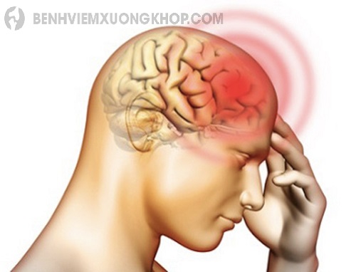 Thoái hóa đốt sống cổ chèn dây thần kinh dẫn đến đau đầu