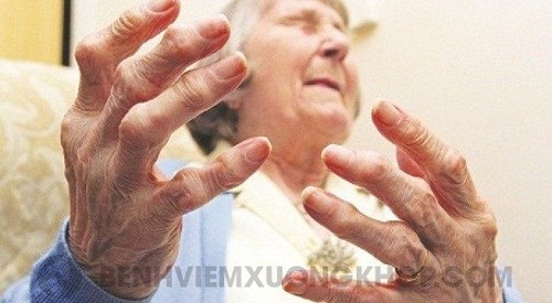 danh sách các bệnh đau khớp thường gặp ngón tay