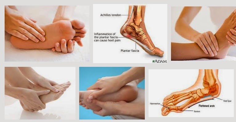Đau gót chân là bệnh gì và cách điều trị