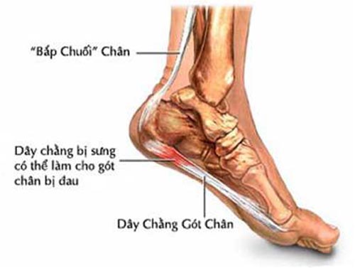 Nhận biết đau gót chân là bệnh gì ?