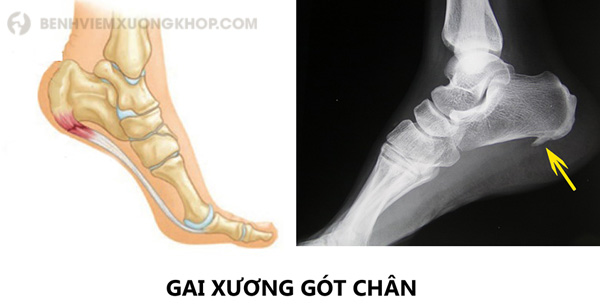 Gai xương là bệnh thường gặp ở người bị thoái hóa khớp, nhất là khớp ngón chân hoặc thoái hóa cột sống