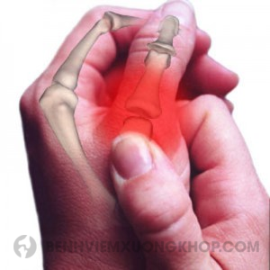 đau khớp ngón tay cái là bệnh gì viêm khớp ngón tay cái