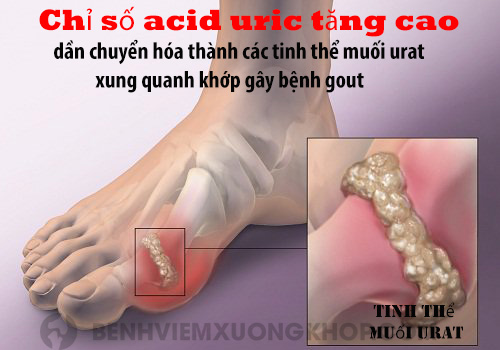 Xác định chỉ số acid uric bao nhiêu là cao để biết bệnh gout
