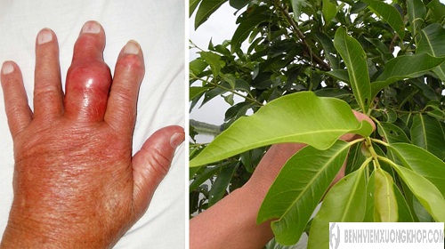 Lá vối có hiệu hoạt chất có tác dụng trị bệnh gout