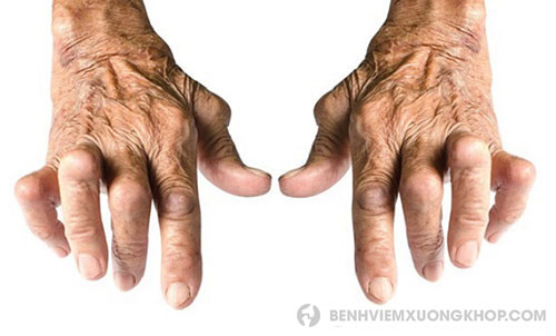 Biến chứng của thấp khớp gây biến dạng các khớp ngón tay