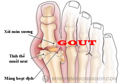ngón chân cái bị đau chủ yếu là do bệnh gout