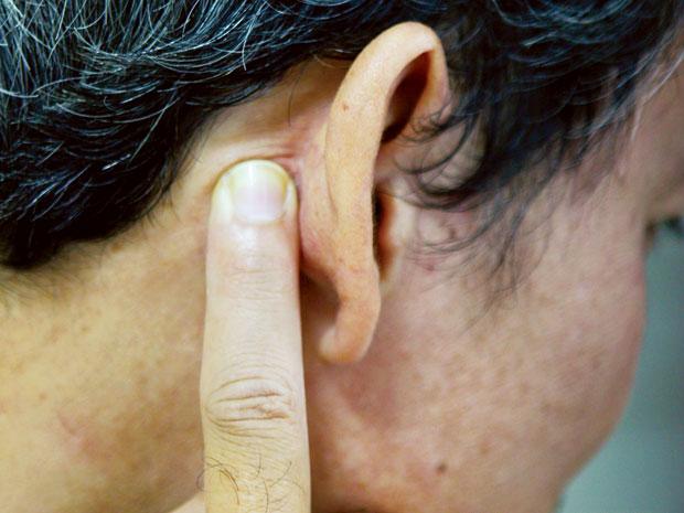viêm xương chủm là nguyên nhân dẫn đến đau dây thần kinh sau tai phải