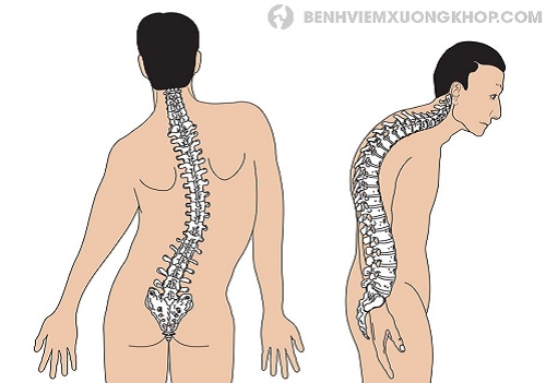 triệu chứng đau cột sống lưng và biến chứng