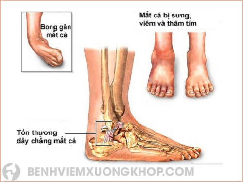 Nguyên nhân dẫn đến bệnh viêm khớp chân 