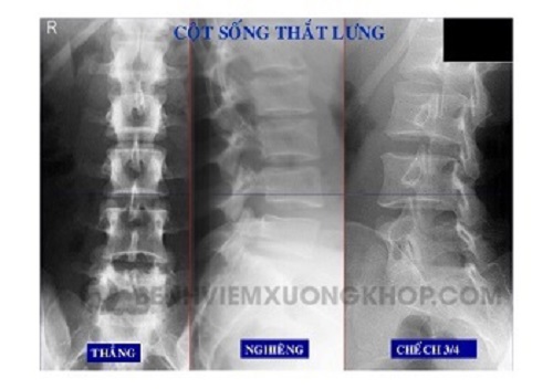 Hình ảnh X-quang thoái hoá cột sống lưng giúp phát hiện những tổn thương nhẹ hoặc có bất thường.