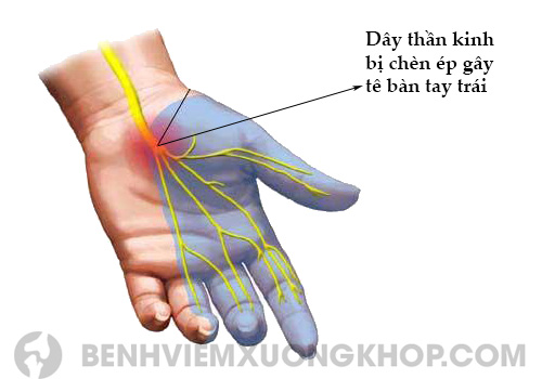 Tê bàn tay trái do chèn ép dây thần kinh