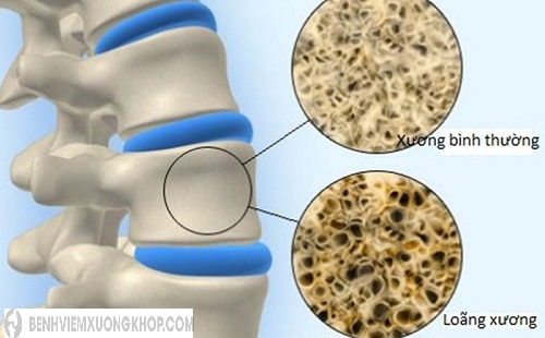 Thiếu canxi là một nguyên nhân gây ra bệnh loãng xương