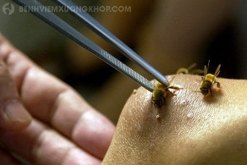 Thực hiện chữa viêm khớp bằng ong châm