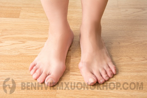 Viêm khớp ngón chân cái gây biến dạng ngón chân