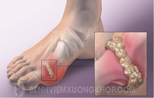 Viêm khớp ngón chân cái gây đau đớn cho người bệnh