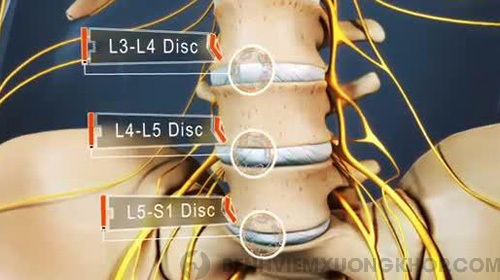 Nguyên nhân gây thoát vị đĩa đệm cột sống thắt lưng l5 s1