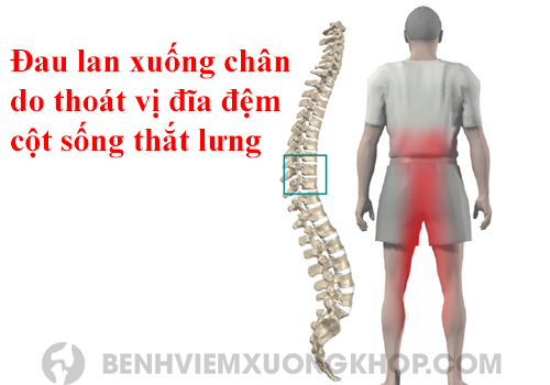 Triệu chứng thoát vị đĩa đệm cột sống thắt lưng đau lan xuống chân