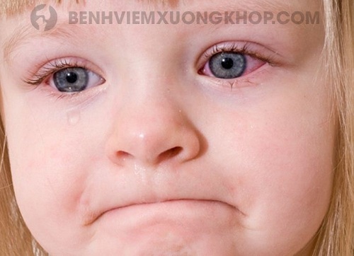 viêm đa khớp dạng thấp ở trẻ em mắt