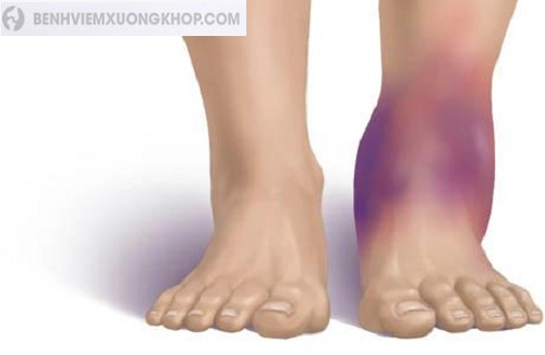 Bong gân có thể dẫn tới viêm khớp cổ chân sau chấn thương