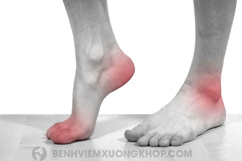 Viêm khớp cổ chân sau chấn thương cơn đau