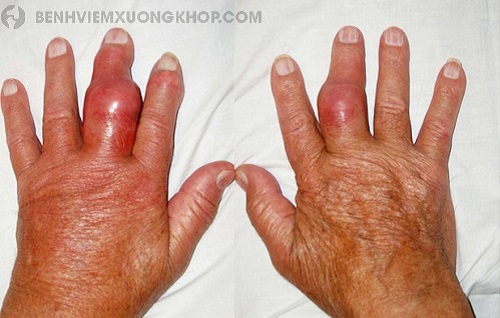 Viêm khớp đốt ngón tay cẩn thận với bệnh lý này