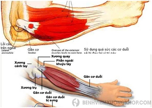 Tìm hiểu bệnh viêm khớp khuỷu tay