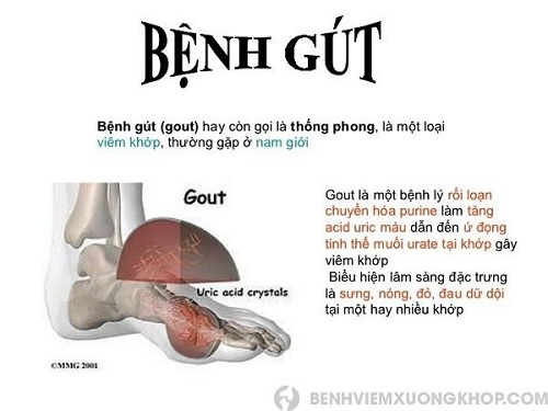 bệnh gout là gì
