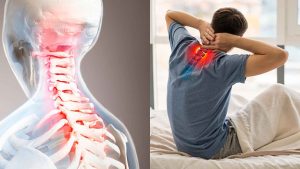 Thoái hóa đốt sống cổ ảnh hưởng lớn đến cuộc sống