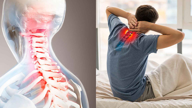 Thoái hóa đốt sống cổ ảnh hưởng lớn đến cuộc sống