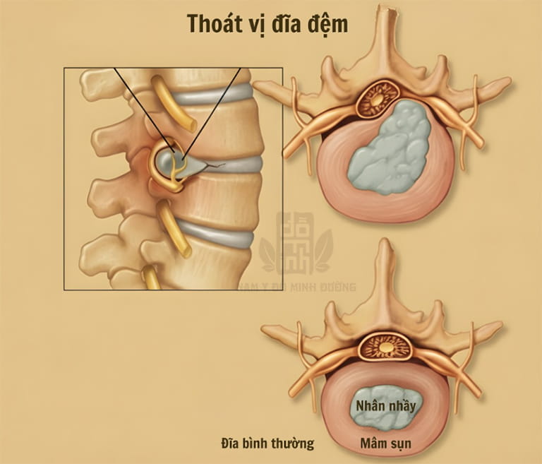 Thoát vị đĩa đệm không thể phục hồi nguyên trạng